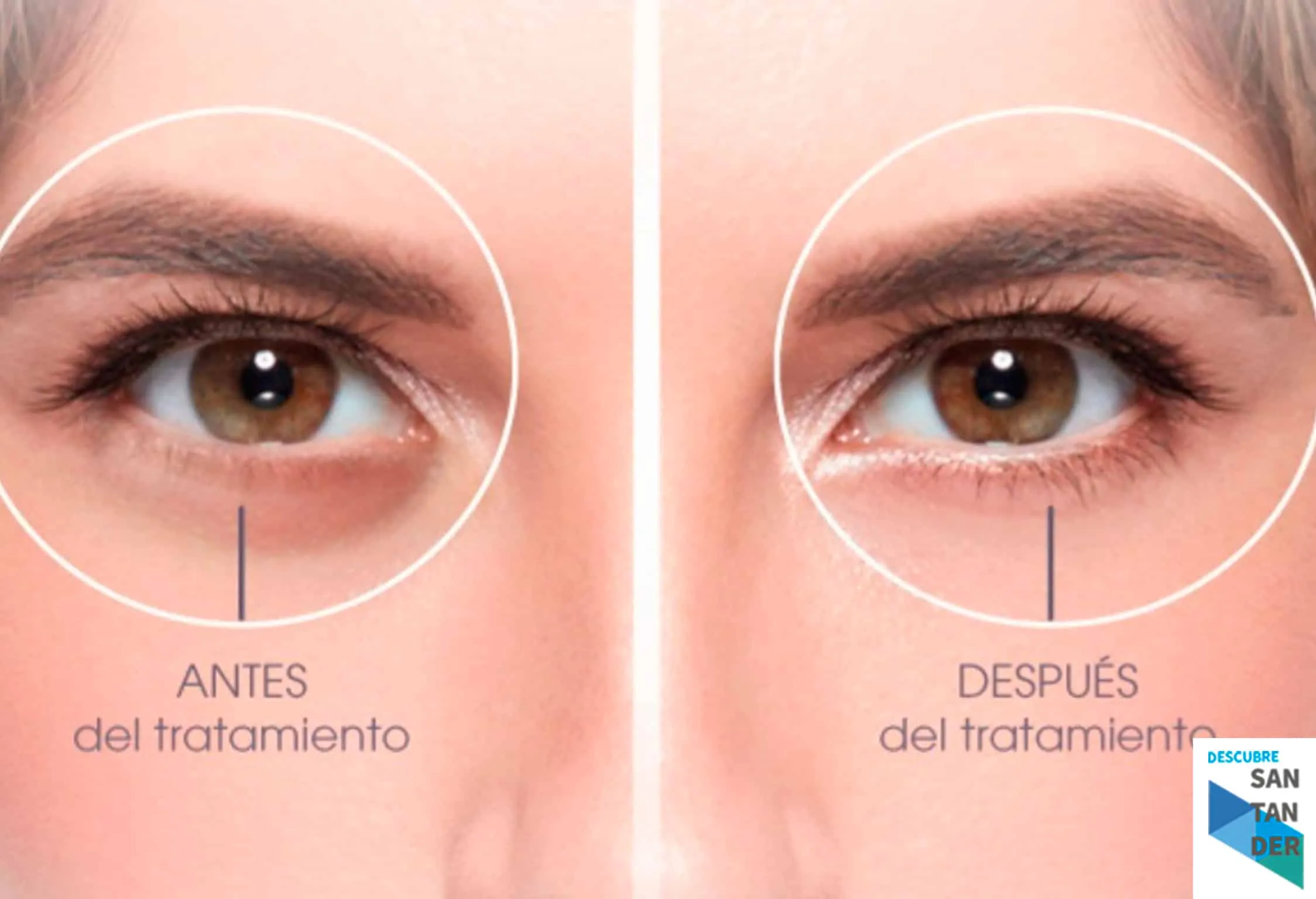 Problemas con tus ojeras estética Inma Martinez