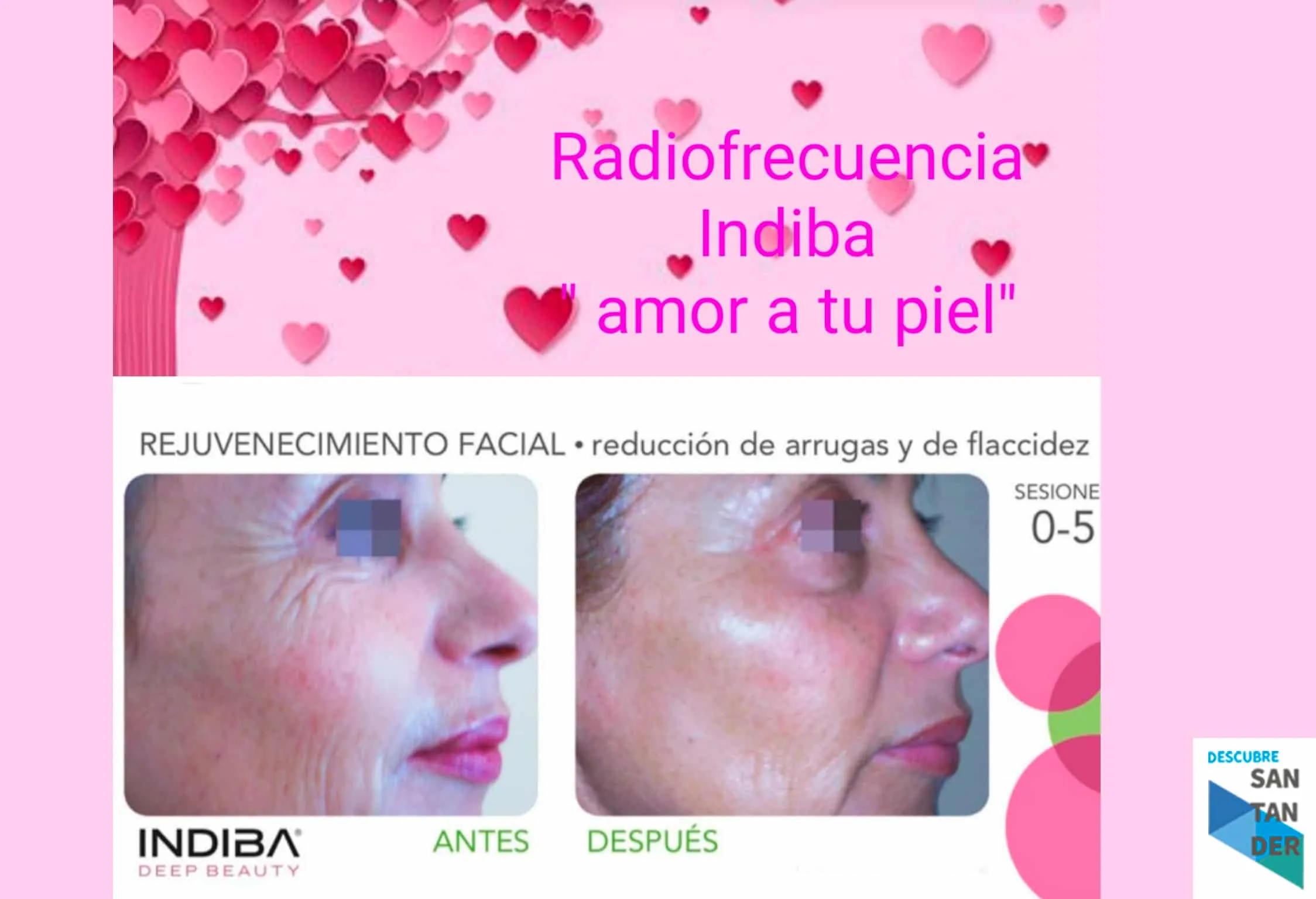Radiofrecuencia Indiba amor a tu piel - Estética Inma Martínez Radiofrecuencia Indiba amor a tu piel - Estética Inma Martínez