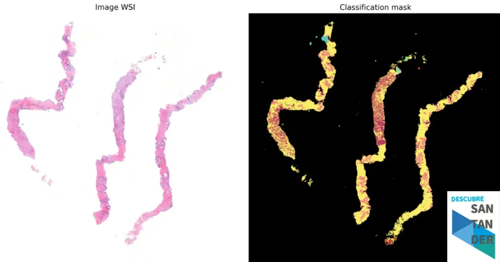 Noticias Santander El Servicio de Anatomía Patológica avanza en el primer algoritmo de IA desarrollado en Valdecilla para el cribado del cáncer de próstata